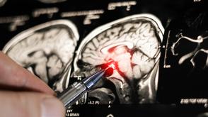 CT-scan of an brain being analyzed.