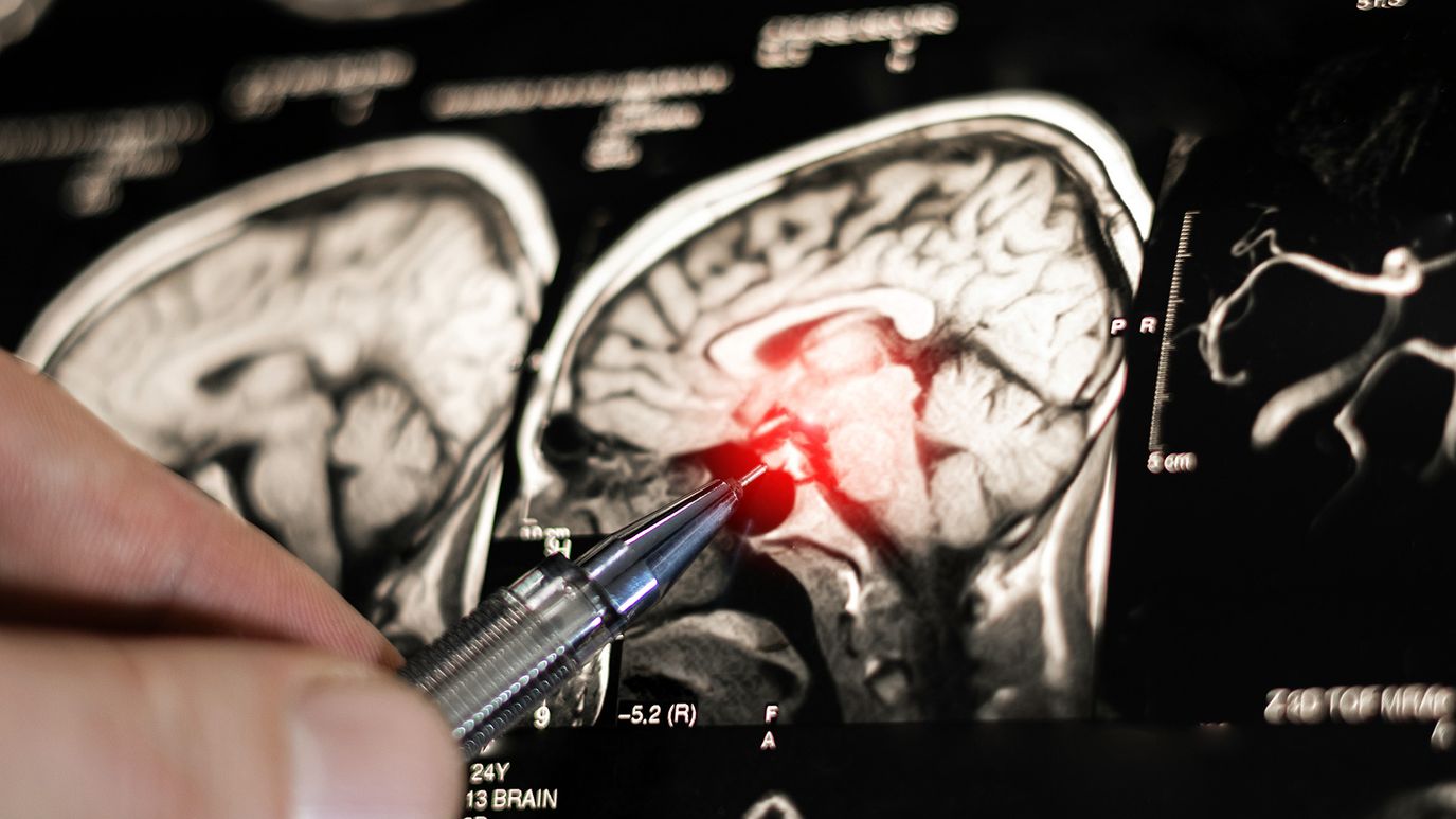 CT-scan of an brain being analyzed.
