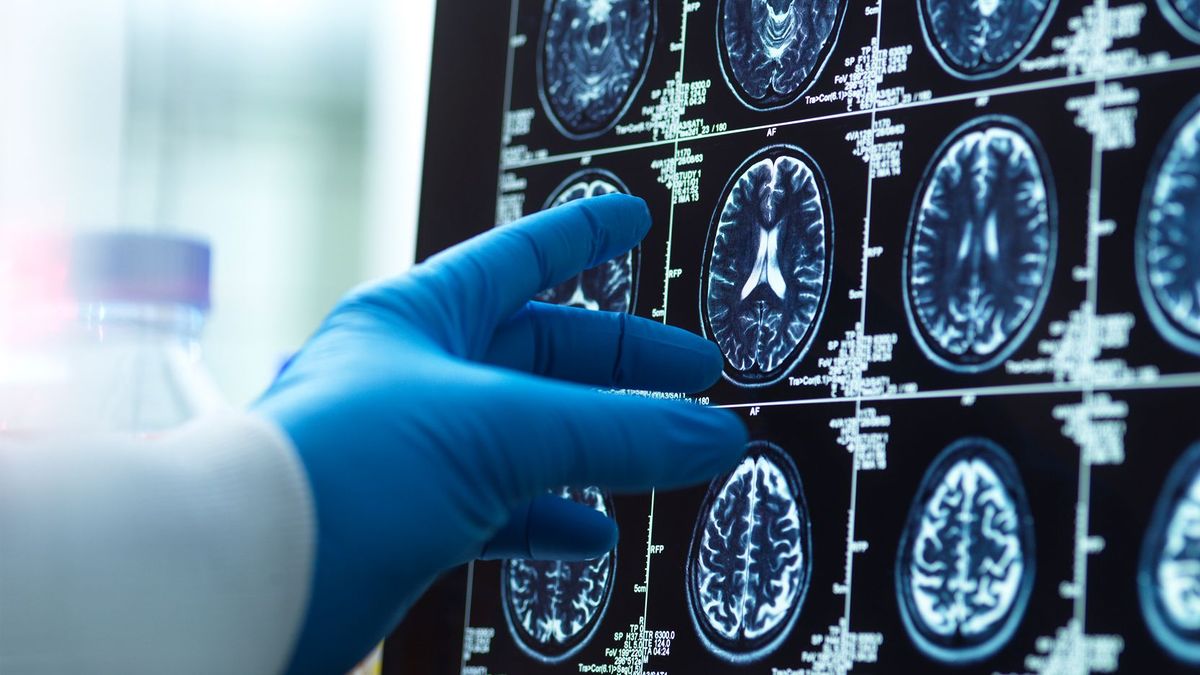 Gloved hand pointing at brain MRI scans displayed on a medical screen.
