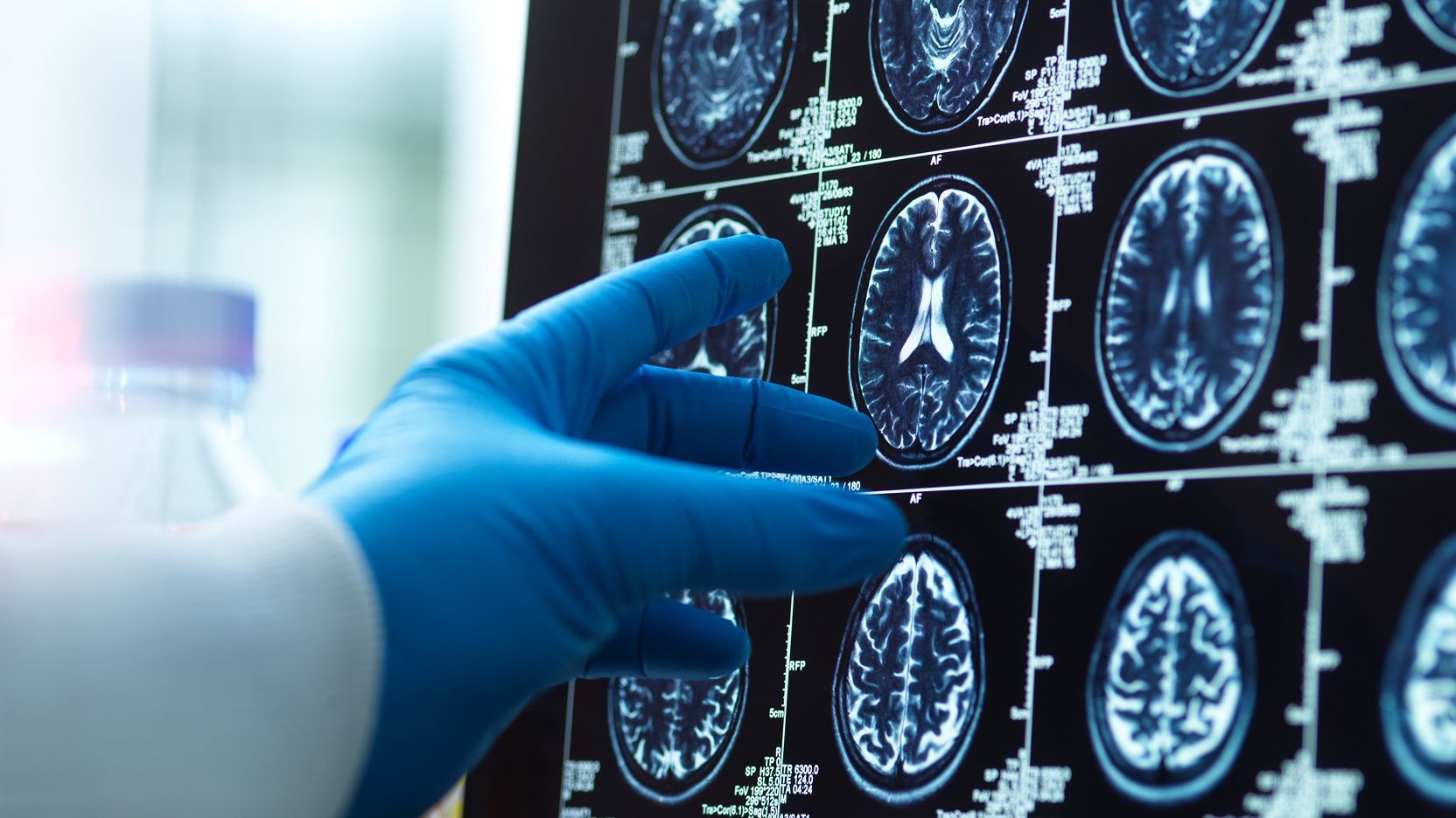 Gloved hand pointing at brain MRI scans displayed on a medical screen.