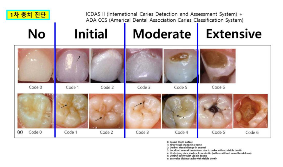 (ステージ別虫歯診断のサンプル画像)