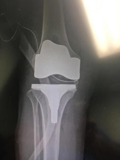 Radiografía de rodilla con  prótesis total.
