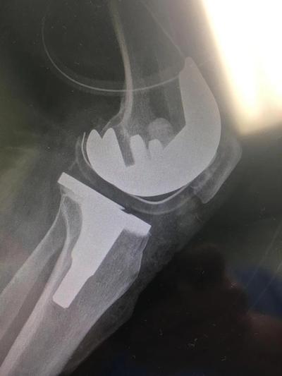 Radiografía de rodilla con prótesis total 