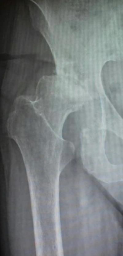 Artrosis severa de cadera derecha