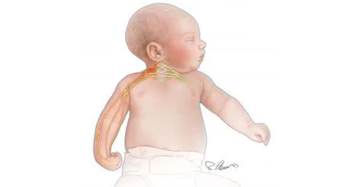 Illustration of an infant's arm affected by Erb's palsy nerve injury