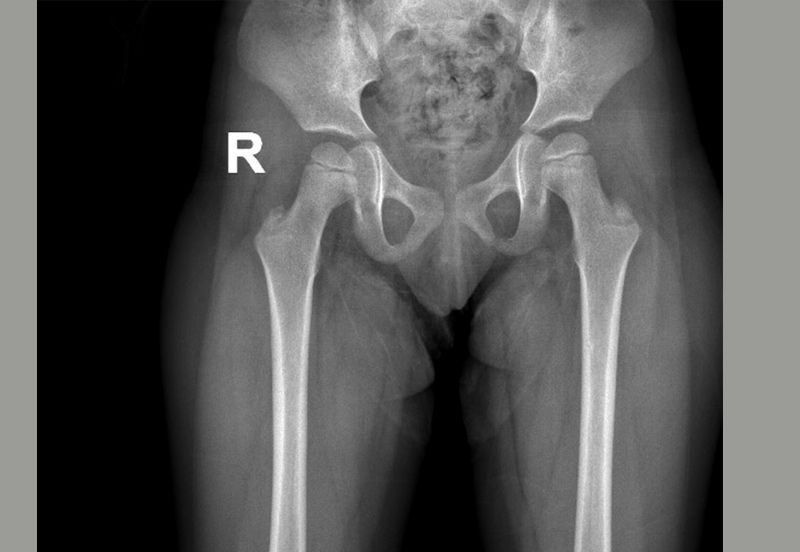 Latest X-ray showing well developed