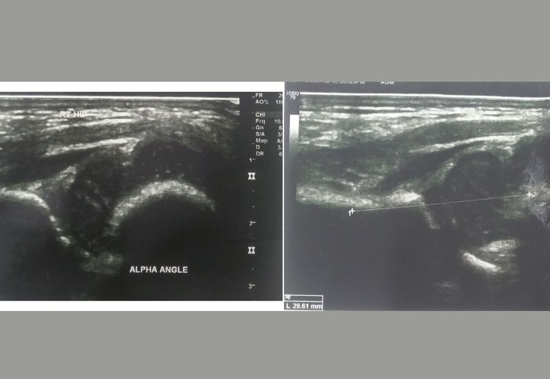 Ultrasound of both hips was advised - which clearly showed DDH in both hips.