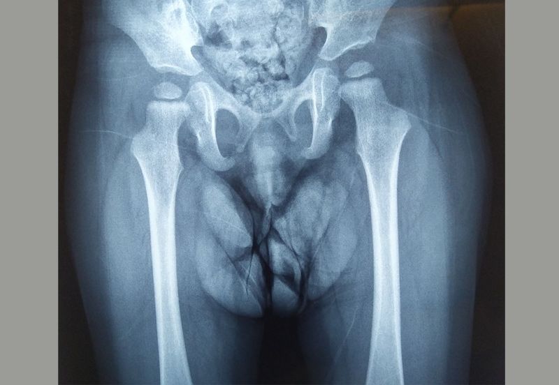 Follow up X-ray - both hips are at their natural place and almost normal X-ray of both hips.