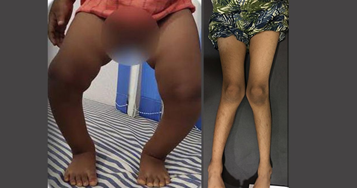 Child's legs showing bow-leg (genu varum) and knock-knee (genu valgum) deformities