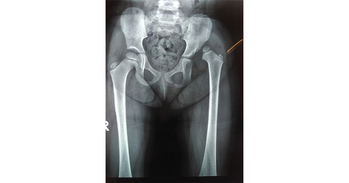 Pelvic X-ray showing developmental dysplasia of the hip