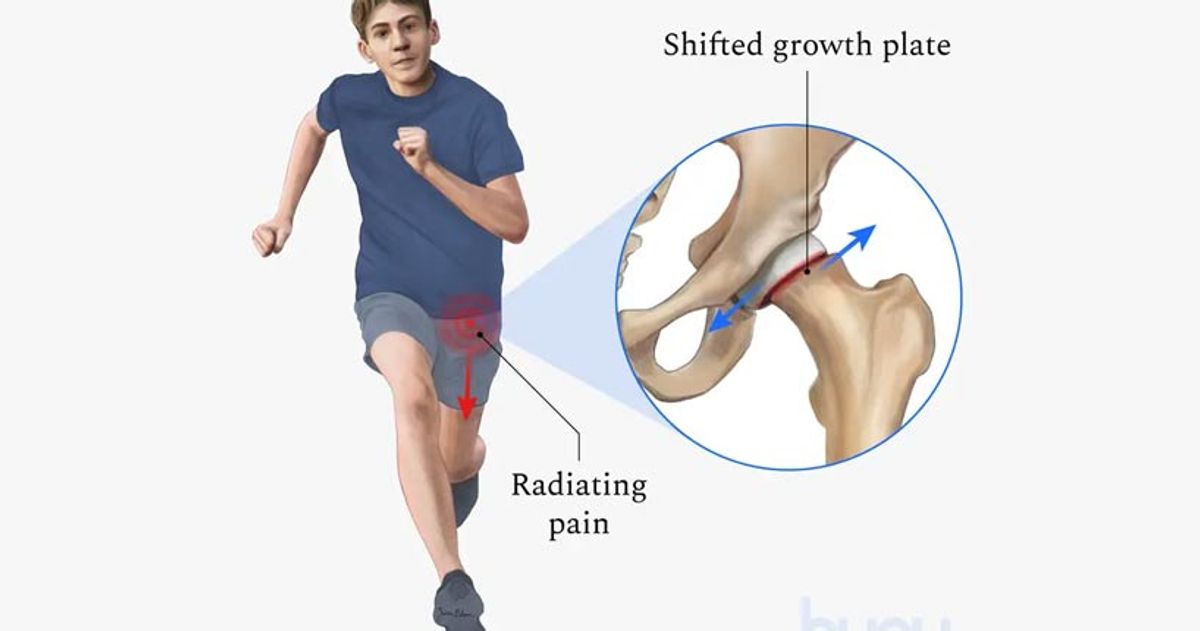 Illustration of a teenager with slipped capital femoral epiphysis showing the shifted growth plate at the hip
