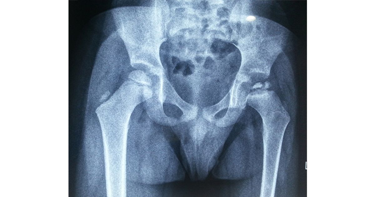 Pelvic X-ray showing Perthes disease of the hip joint