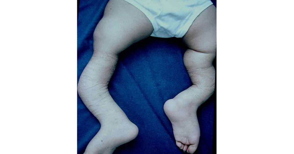 Infant's legs showing bowing deformity typical of osteogenesis imperfecta