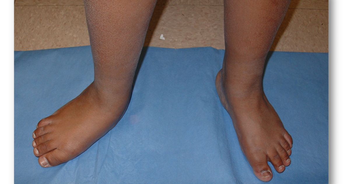 Child's feet showing flat foot deformity from tarsal coalition