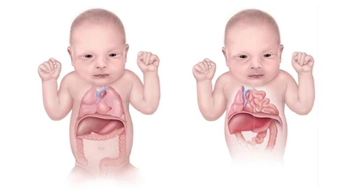 Illustration of two infants showing internal congenital anomalies