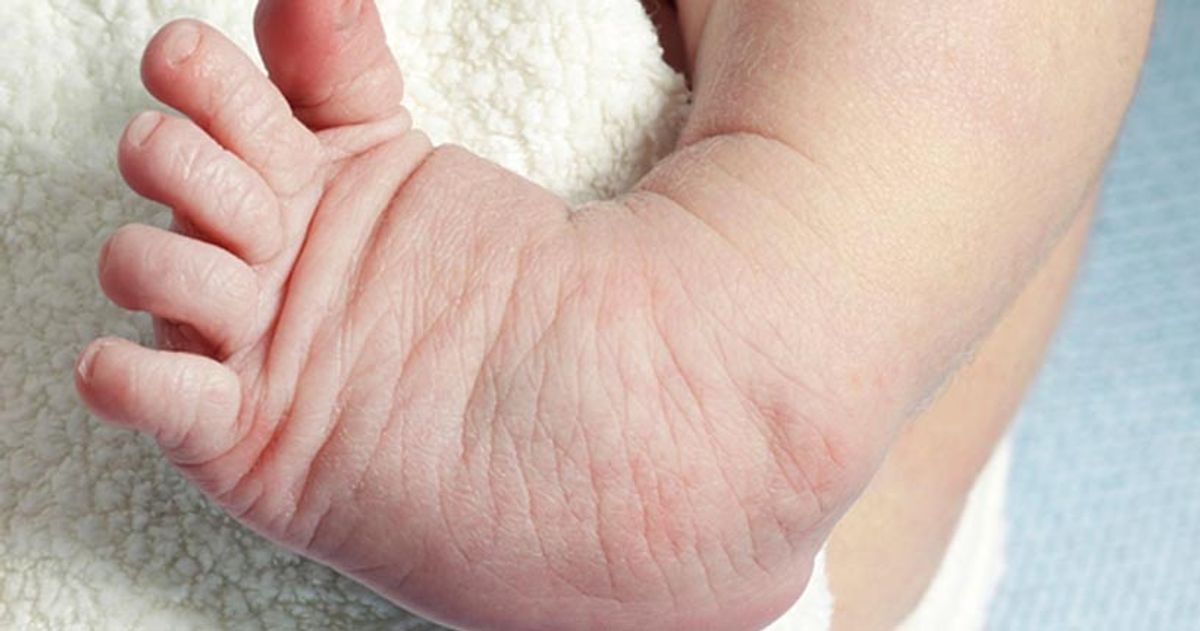 Newborn's foot showing clubfoot (CTEV) deformity