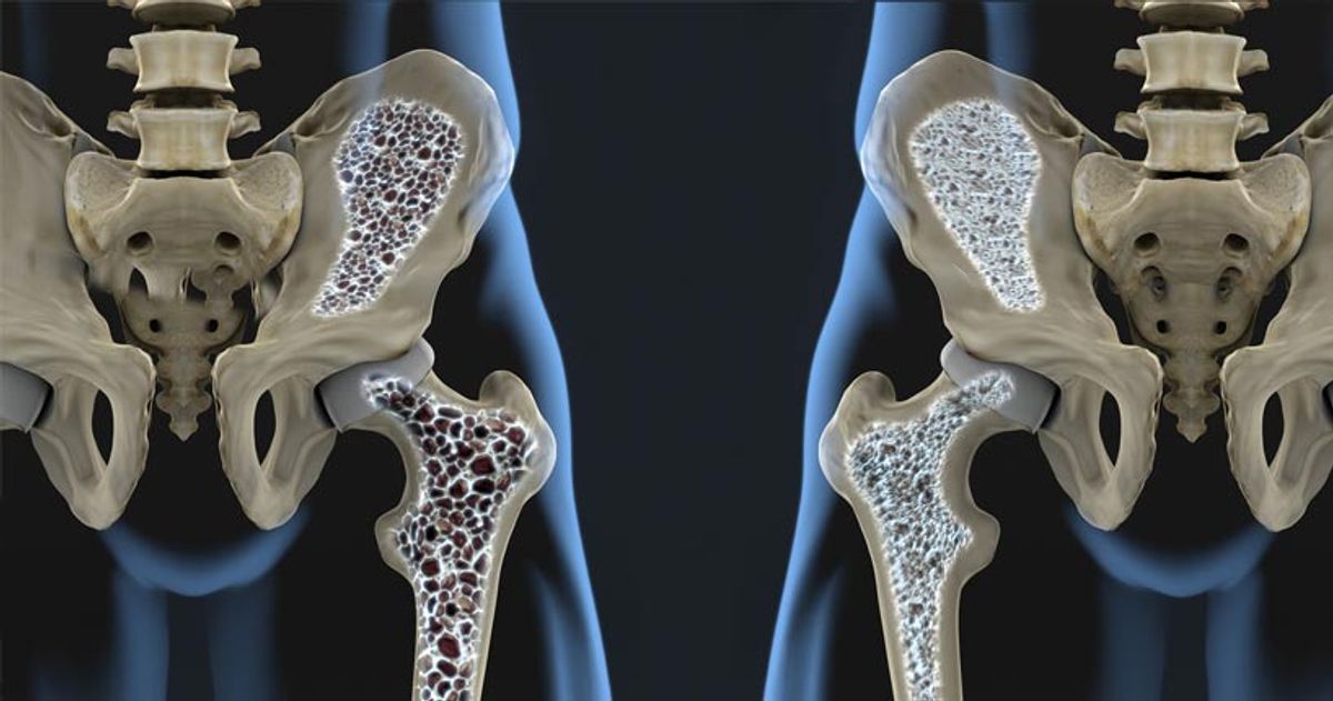 Illustration comparing a healthy hip bone to one weakened by rickets