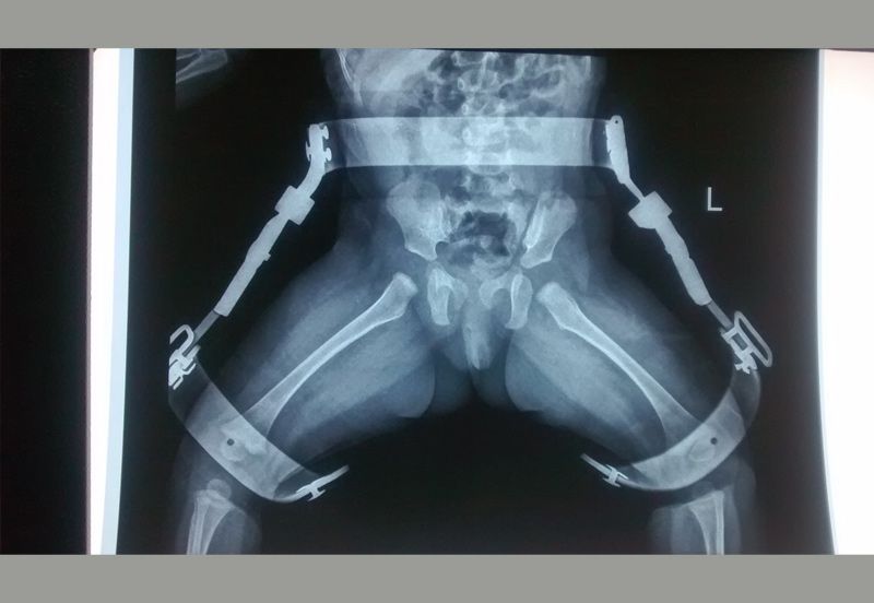 After 6 months of age, the child was maintained in hip abduction brace.