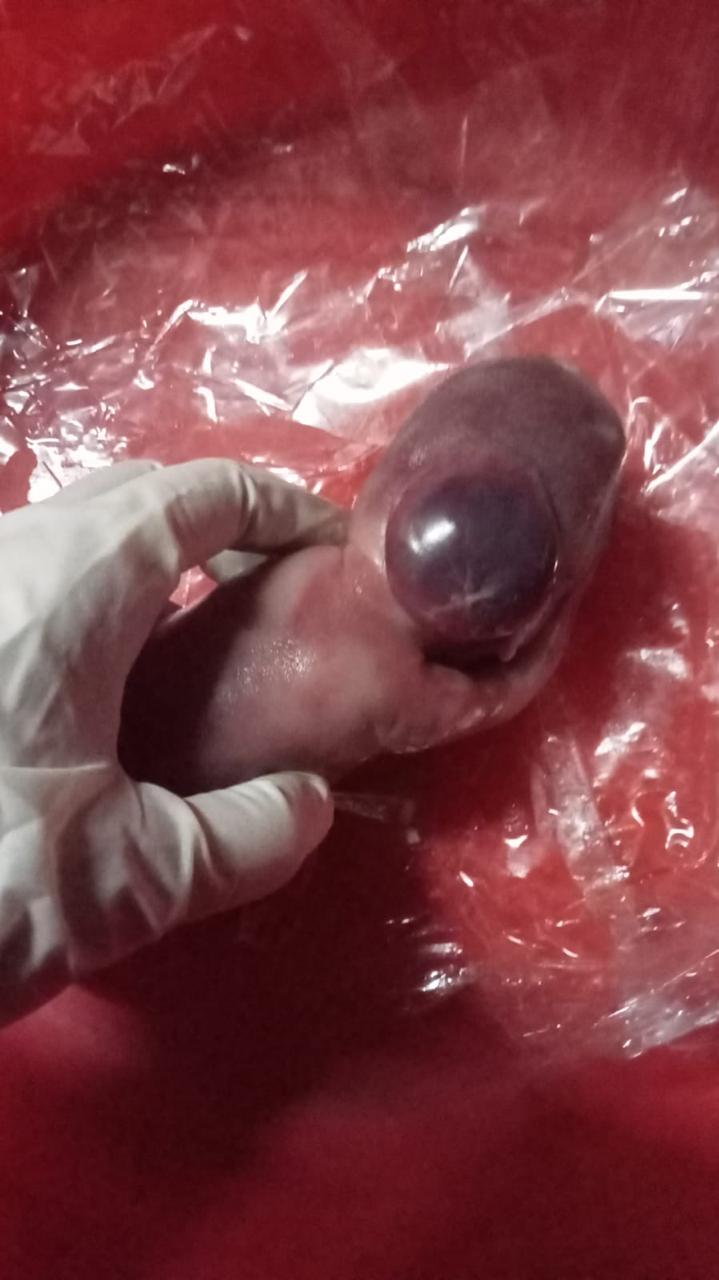 Congenital Abnormality / Omphalocele