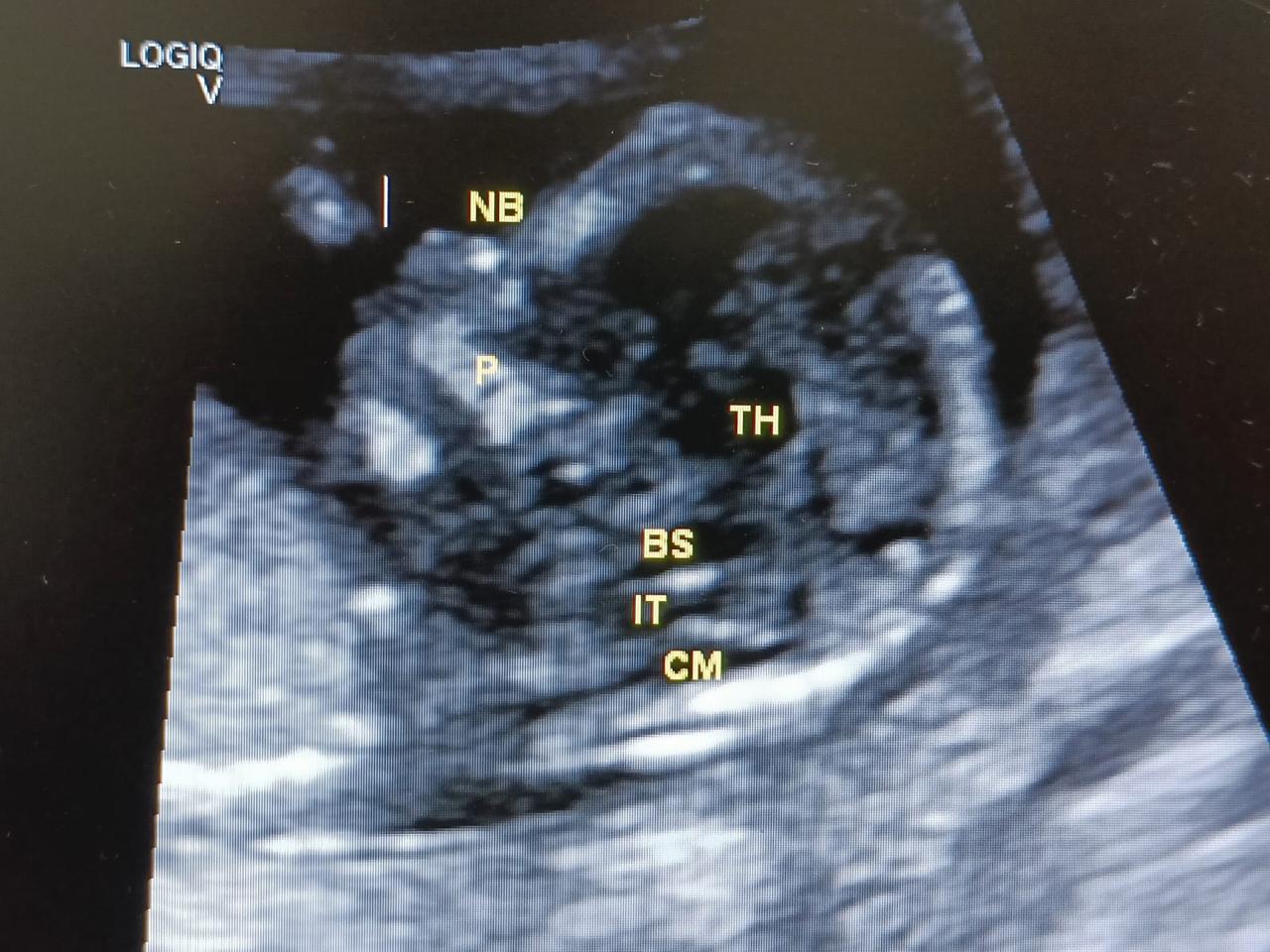 Advanced Fetal Neurosonography