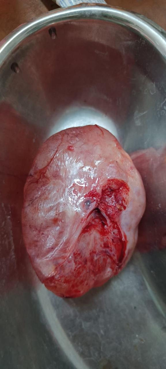 Gross Pathology of Uterine Leiomyoma