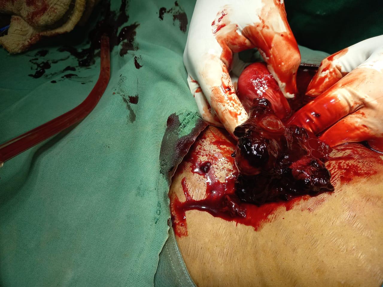 Ectopic Surgery