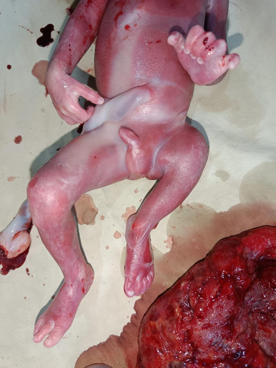 Prune Belly Syndrome / Congenital Abdominal Defect