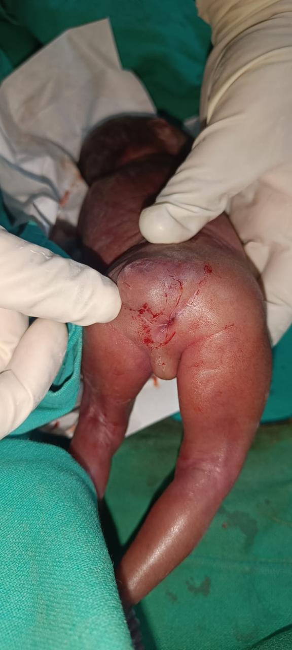Neonatal Sacrococcygeal Teratoma (SCT)