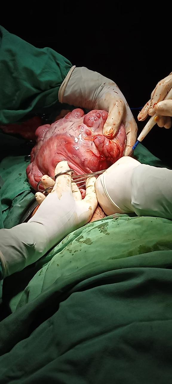 Large Uterine Fibroid / Myoma