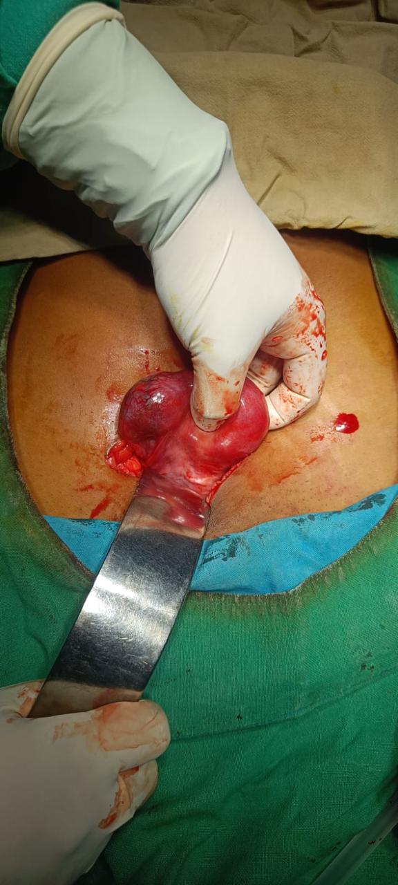 Ectopic Pregnancy Surgery