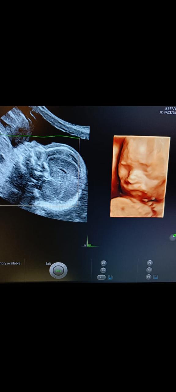 3D Fetal Facial Profiling
