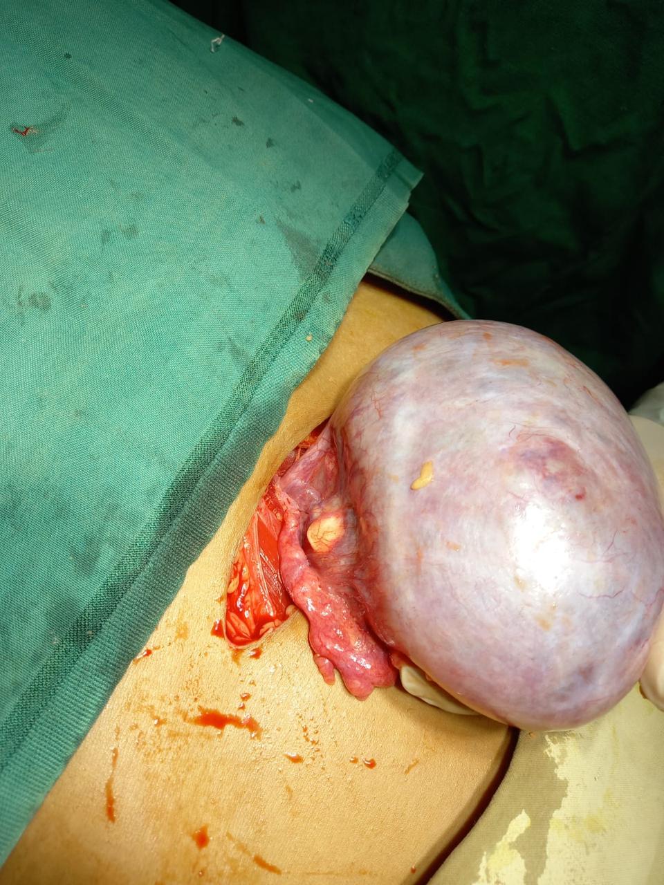Ovarian Cyst