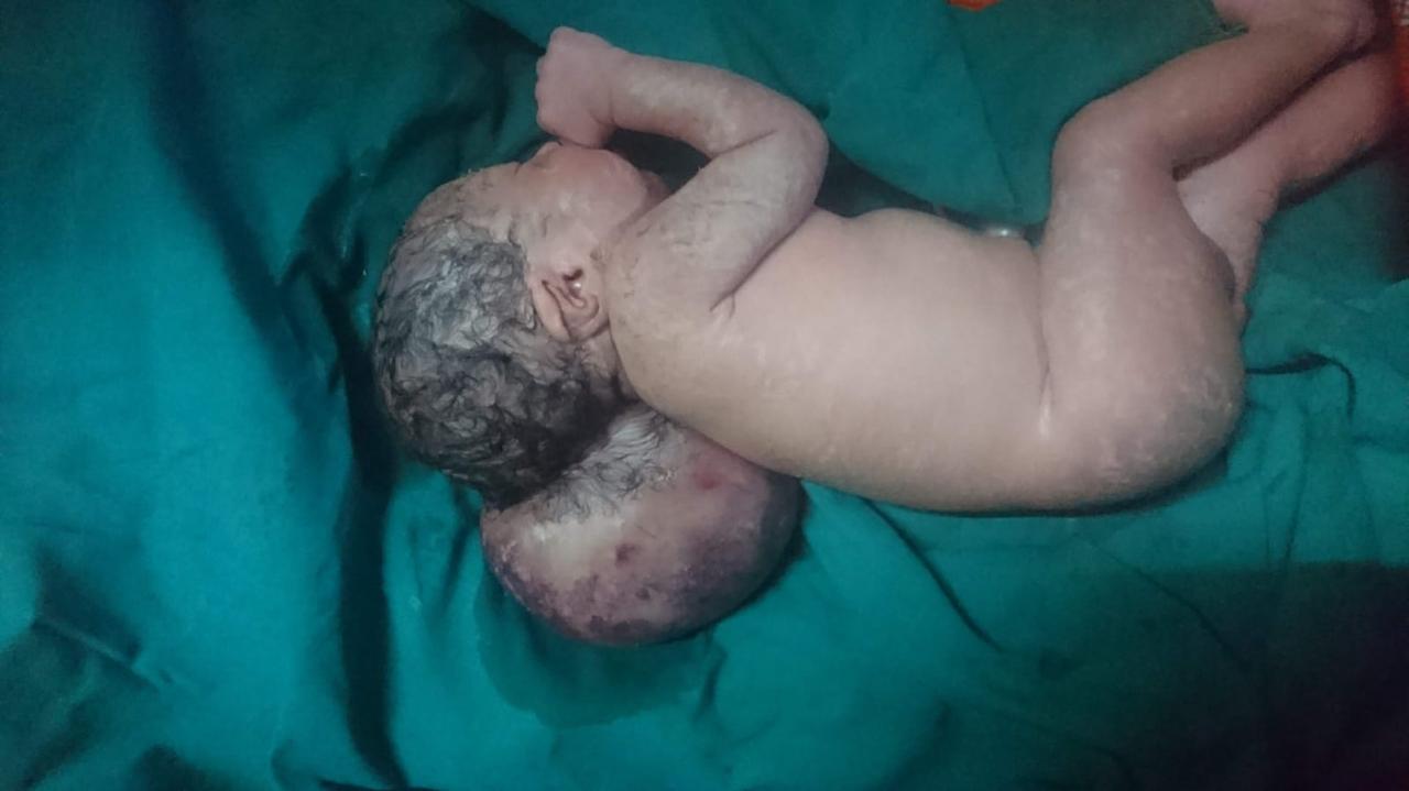Neonatal Neural Tube Defect