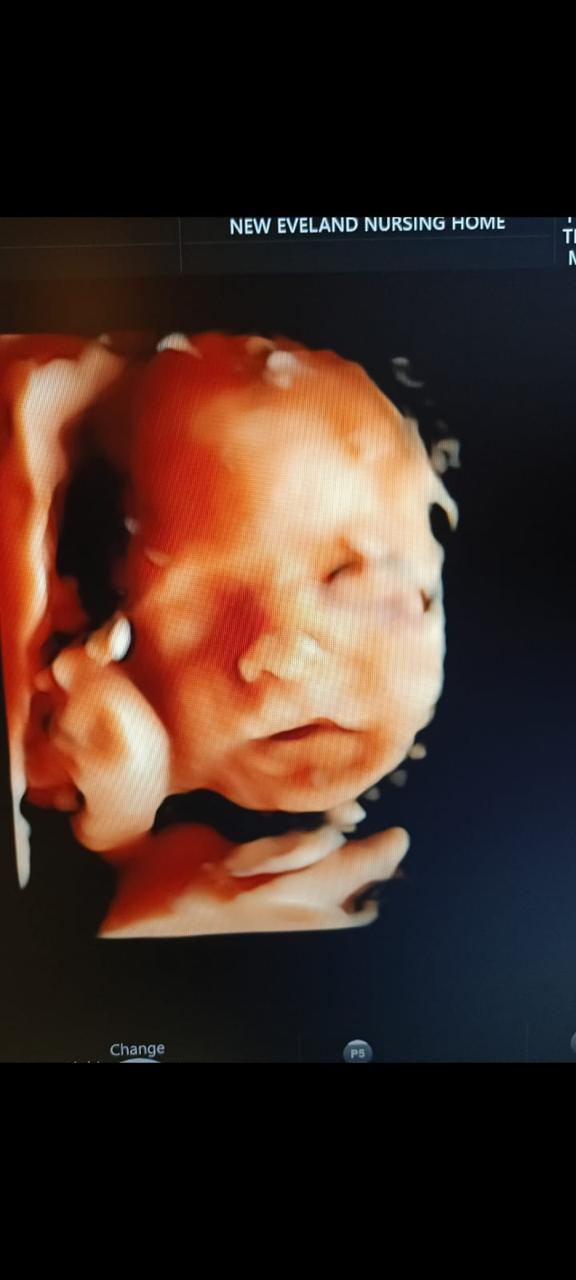 3D Fetal Face