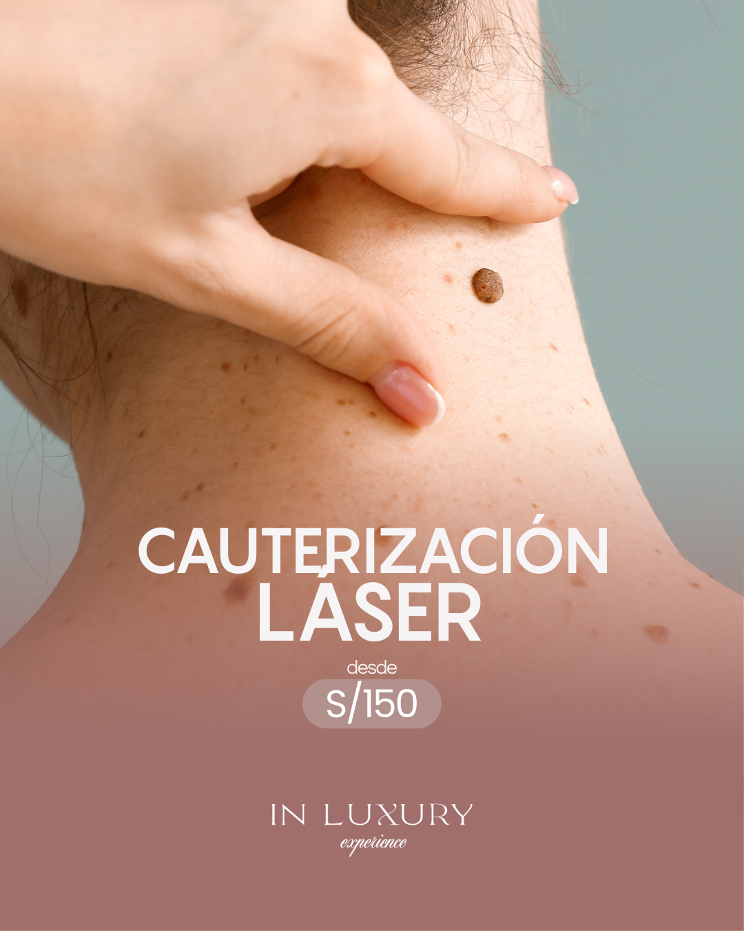 Cauterización Láser desde S/150 - In Luxury Experience