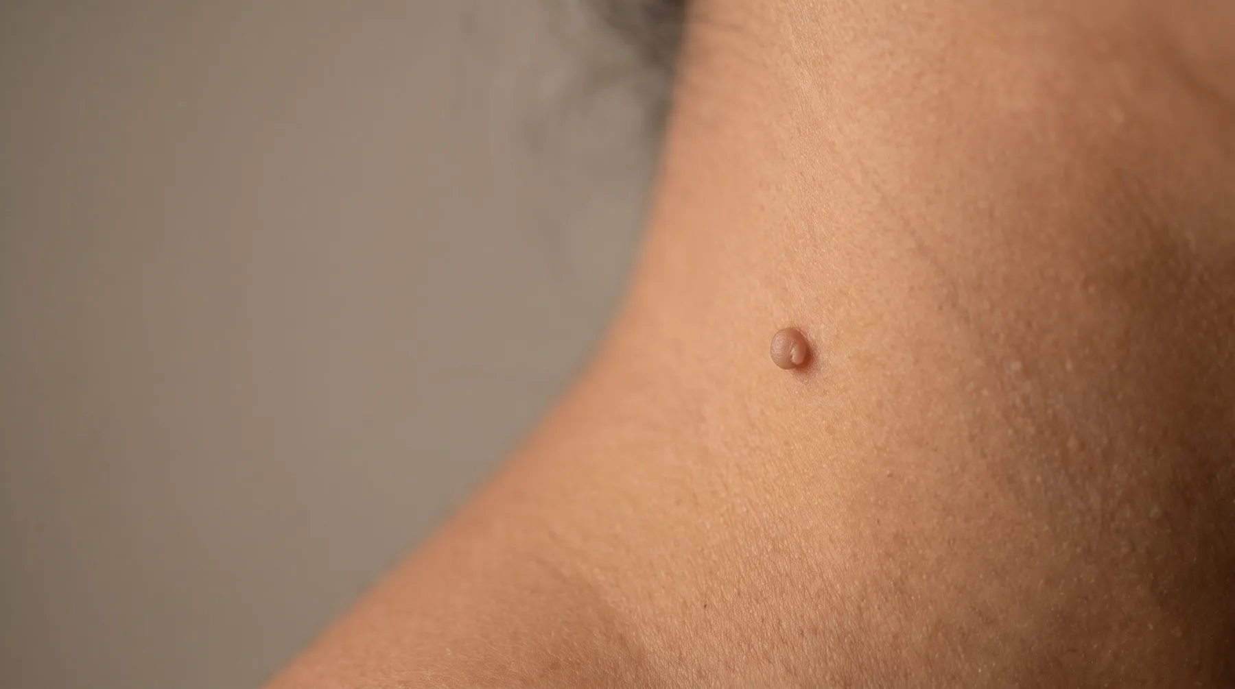 Skin tag on the neck, close up — PROVEN personalized skincare