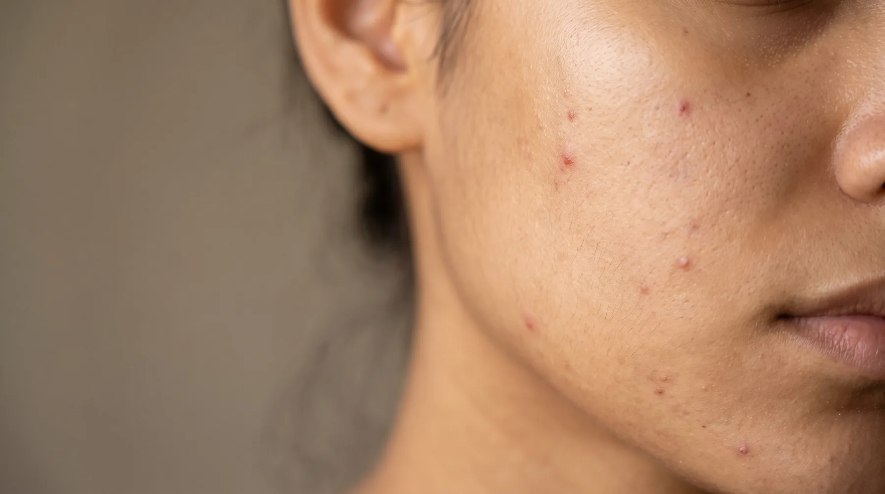 Acne-prone skin, close up — PROVEN personalized skincare