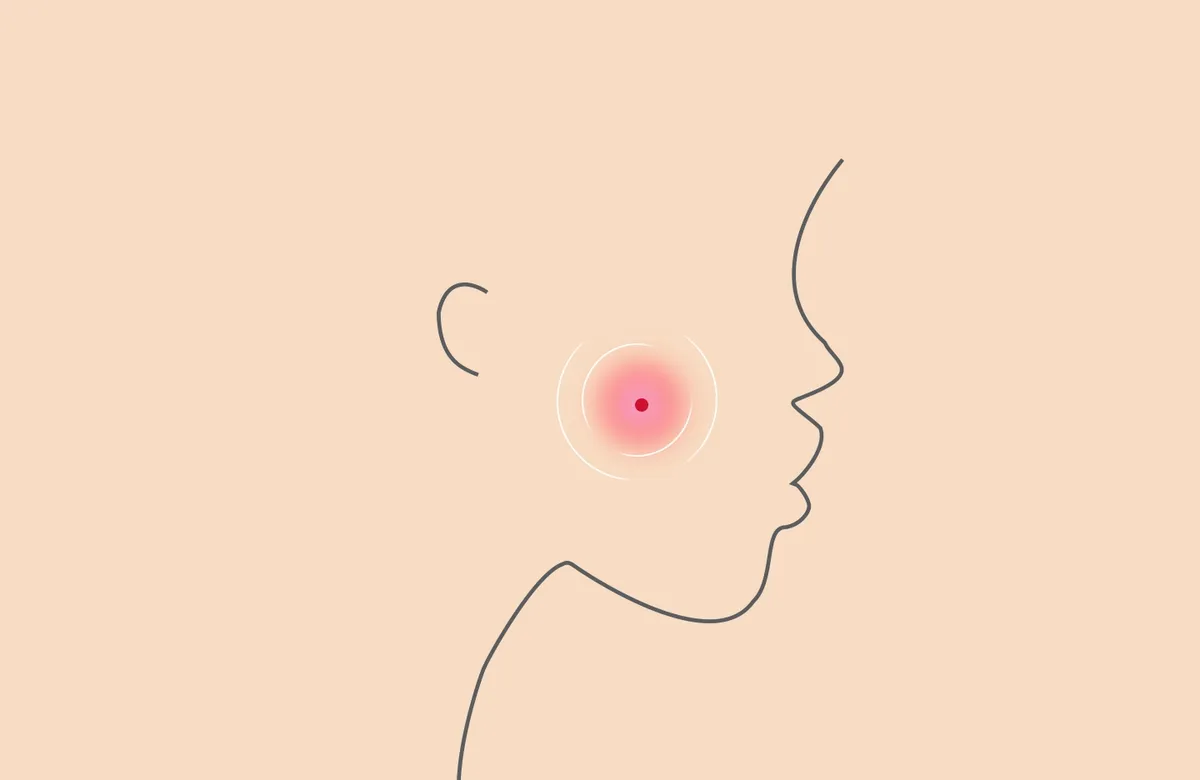 Causes of Acne in Adults: The List of Reasons & Treatments