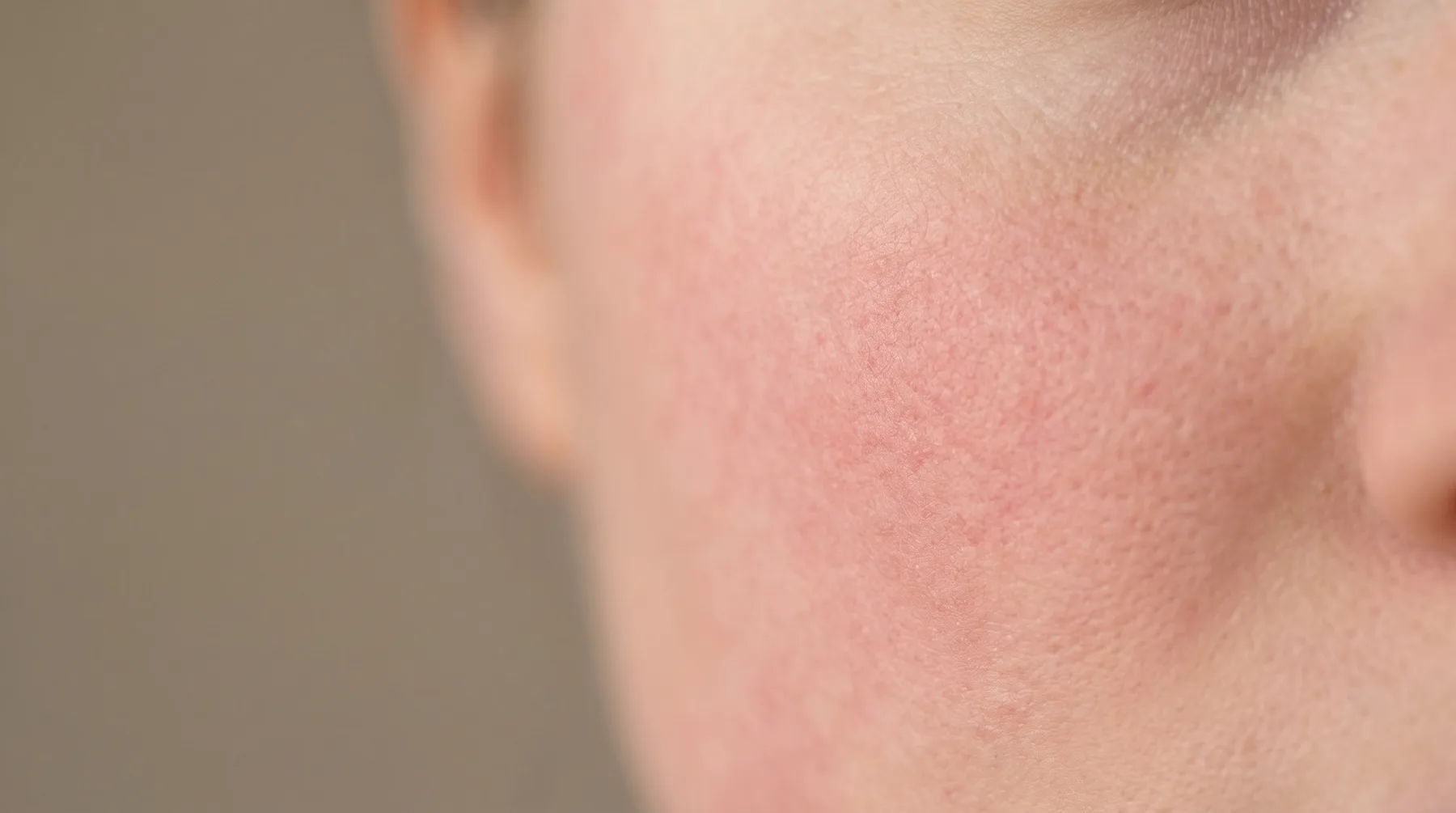 Skin with redness and sensitivity, close up — PROVEN personalized skincare