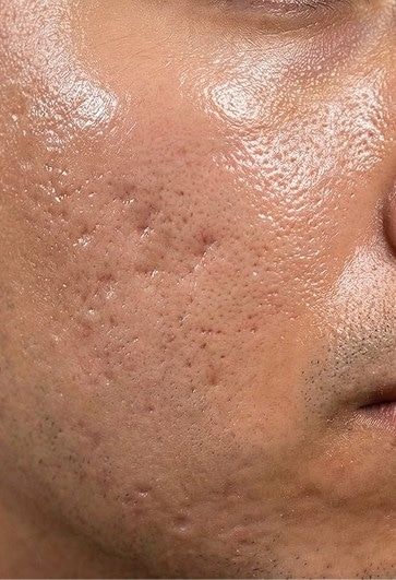 Before photo of a person's cheek with oily skin and acne scarring.