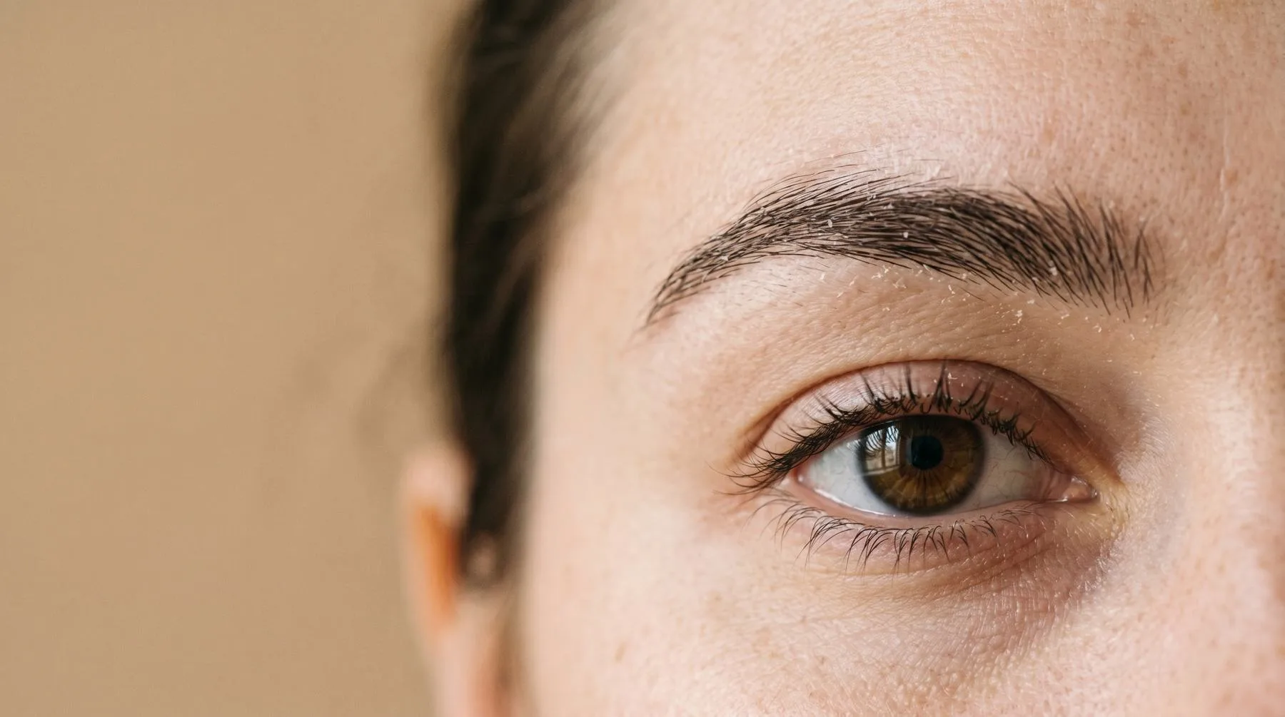 Eyebrow dandruff — brow close-up with flaking