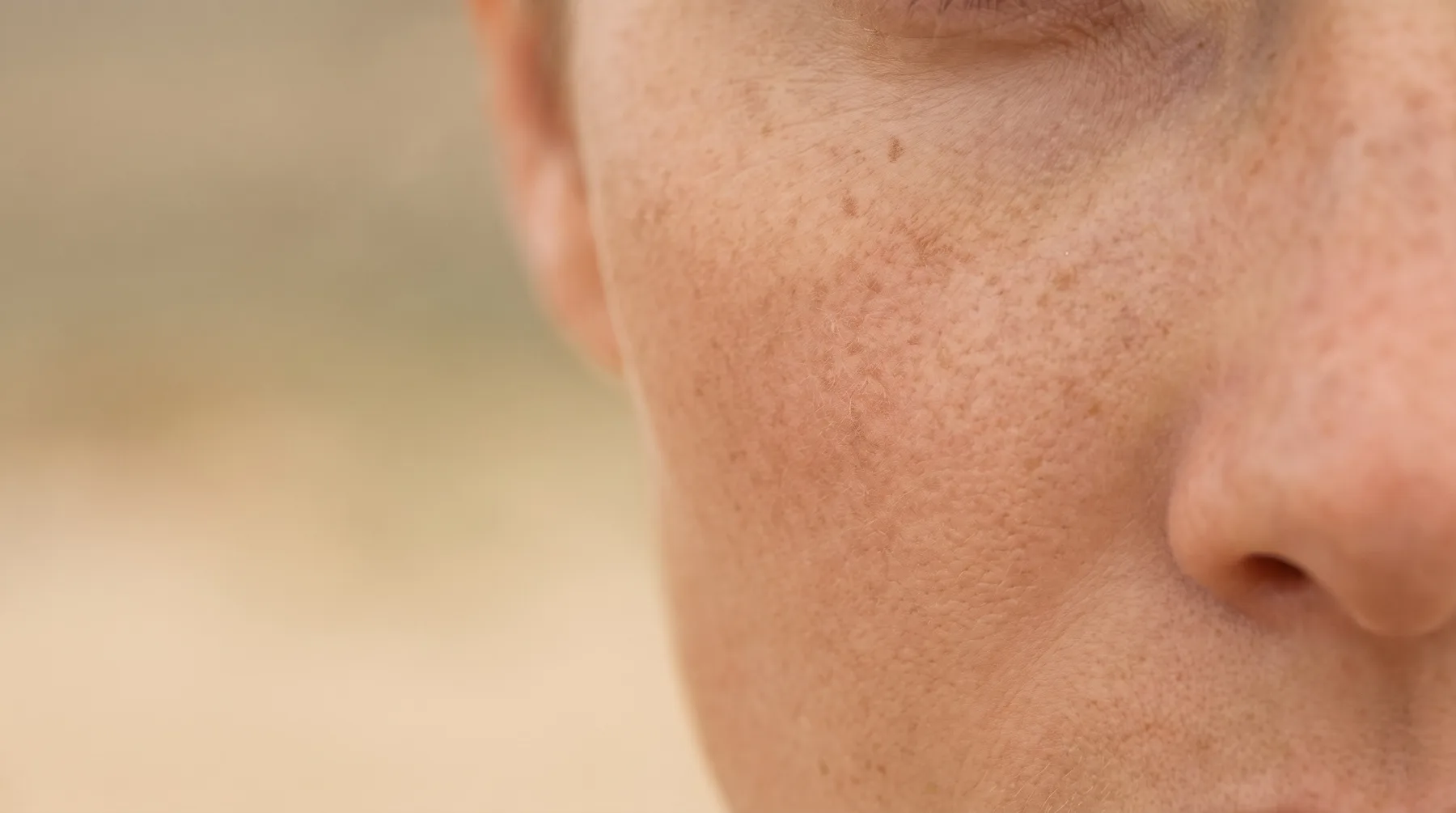 Sun-exposed skin with freckles and sunspots, close up — PROVEN personalized skincare