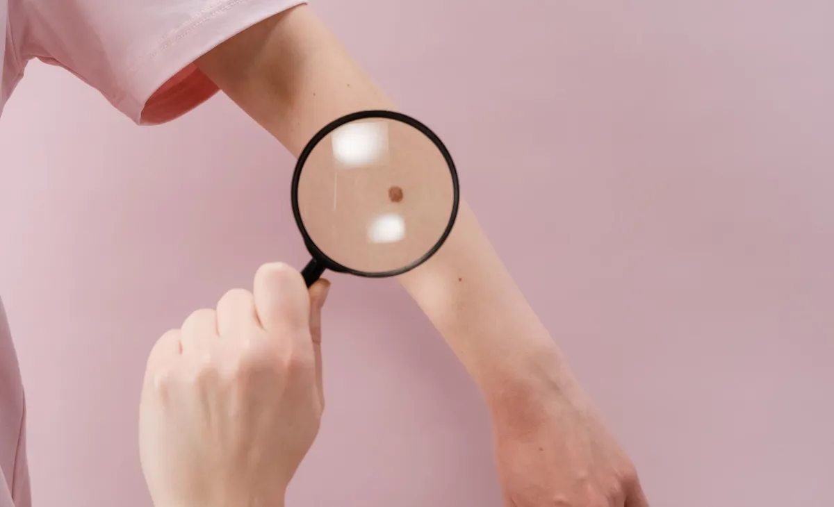 How To Get Rid Of Moles On Skin: Is It Safe?