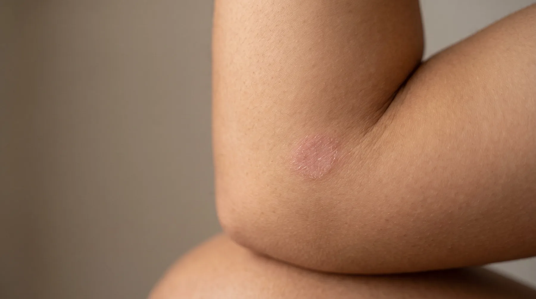 Skin with mild eczema, close up — PROVEN personalized skincare