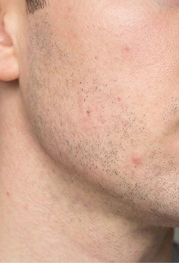 After photo showing fewer razor bumps and reduced skin sensitivity after using Proven.