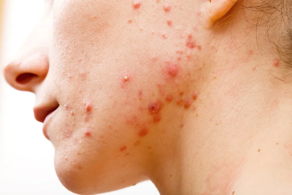 Does Vaping Cause Acne & Your Skin To Age Faster? — PROVEN personalized skincare