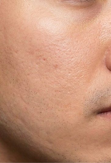 After photo showing reduced scarring after using Proven's personalized skincare.