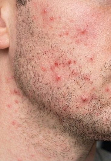 Before photo of a man's jawline with razor bumps and skin sensitivity.