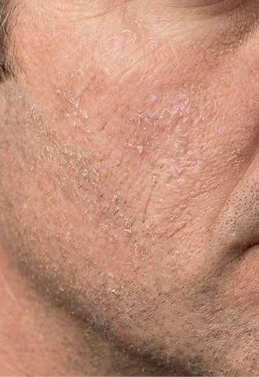 Before photo of a man's cheek showing dryness and rough texture.