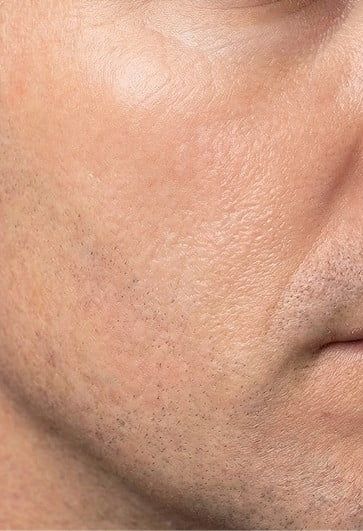 After photo showing less dryness and smoother texture after following the Proven routine.